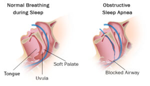 Sleep Apnea and Erectile Dysfunction How Are They Related